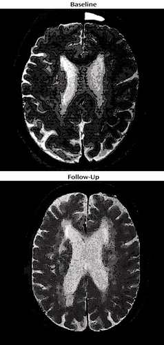 Progression of Subcortical Ischemic Disease From Vascular Depression to ...