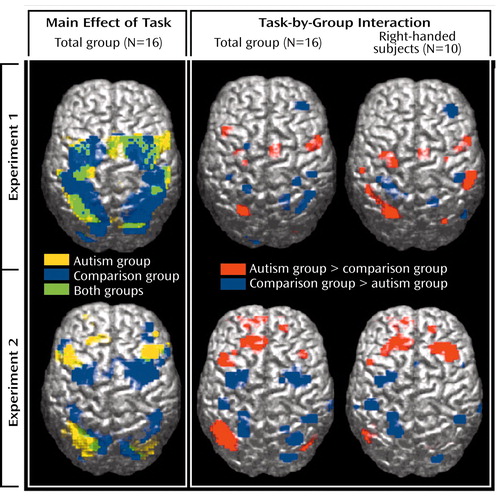 autism brain comparison